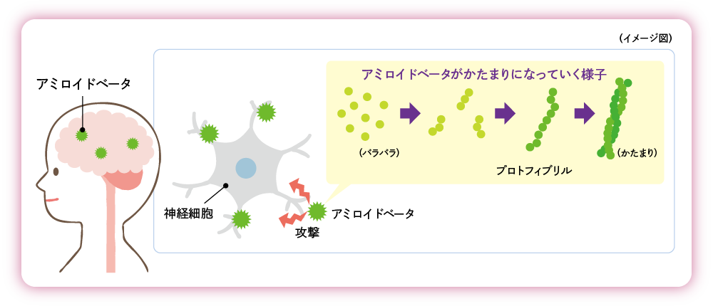 アルツハイマー病とは